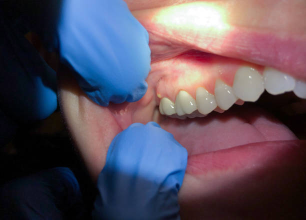 Best Emergency Dental Extractions in Hoisington, KS